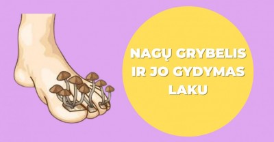 Nagų grybelis ir jo gydymas laku: kokie pliusai?